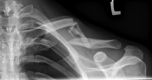 Clavicle Fracture Skin Tenting